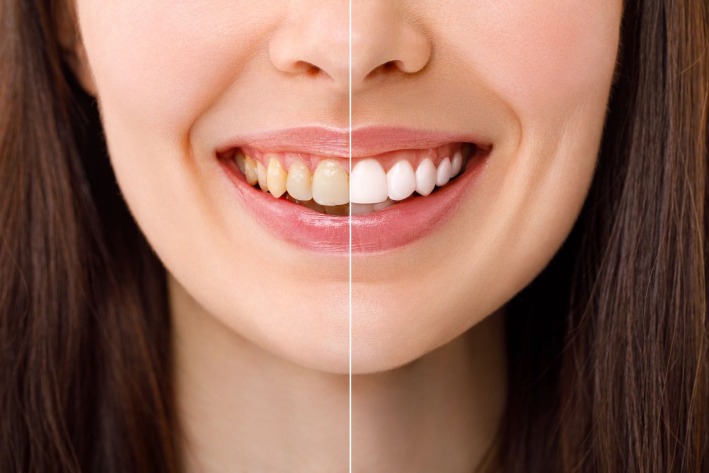 Teeth Whitening in Tysons Corner, VA