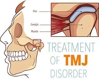 TMJ / TMD Treatment in Tysons Corner, VA